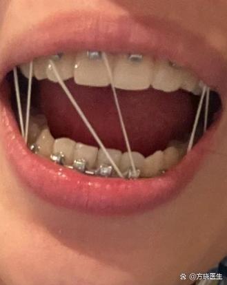 拔虎牙能种牙吗-图1