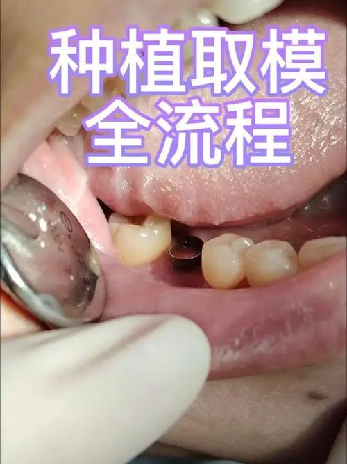 种牙后取模到底要等多久？最佳时间是什么时候？-图1