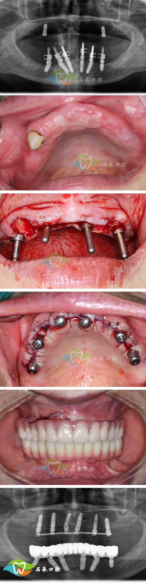 下颚骨拔一颗牙正畸-图1 下颚骨拔一颗牙正畸-图1