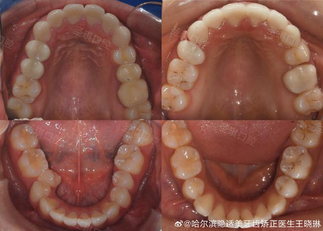 下颚骨拔一颗牙正畸-图3 下颚骨拔一颗牙正畸-图3