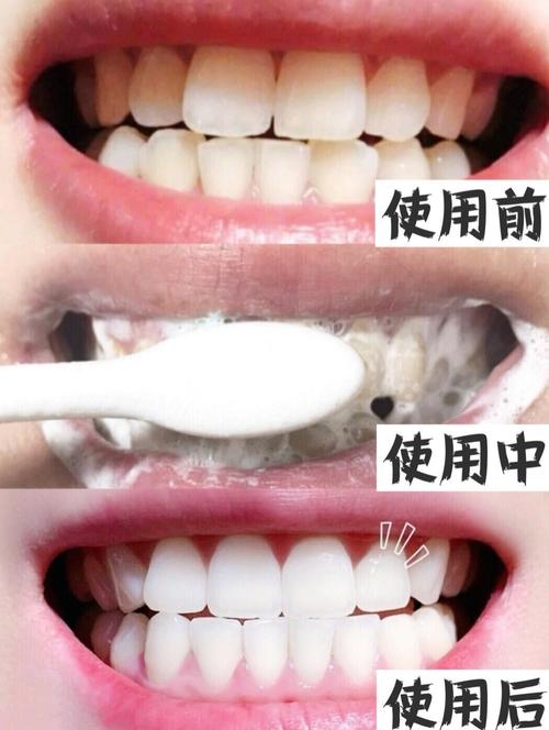 美白牙齿方法-图3