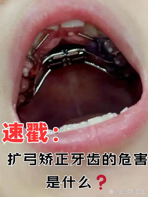 正畸几个月用带扩弓-图1