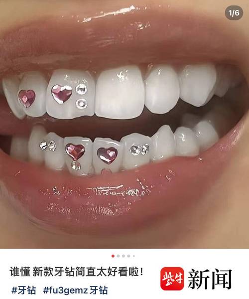 镶牙钻孔方法的关键步骤和要点是什么？-图2