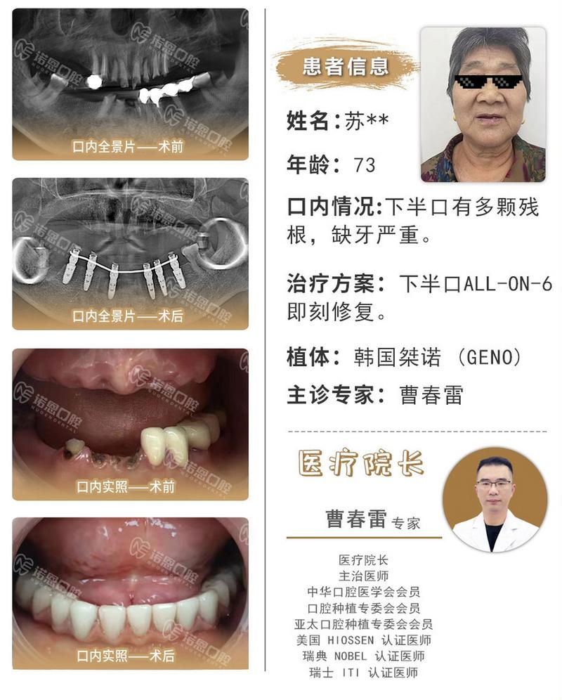 老人不适合种牙?其实这些情况也能种,关键看这几点?-图2 老人不适合种牙?其实这些情况也能种,关键看这几点?-图2