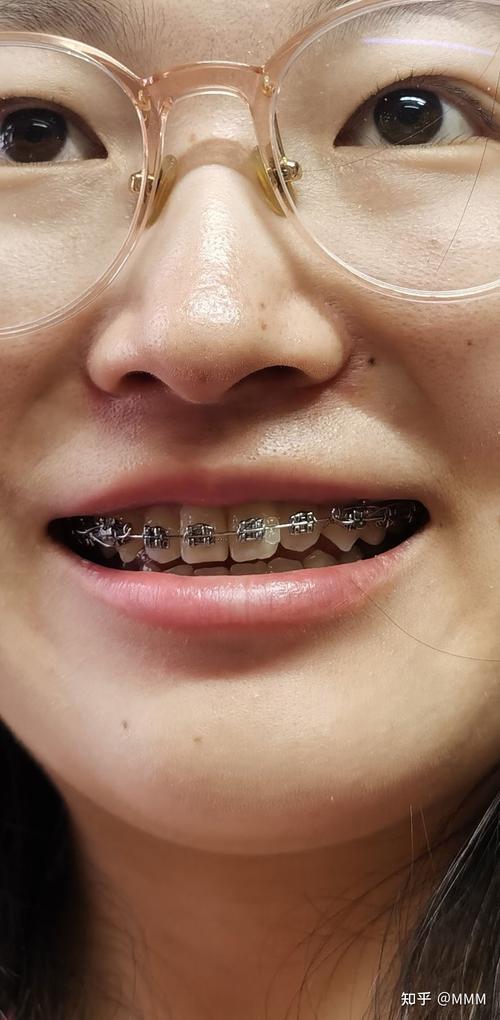 南京医科大学正畸马医生矫正效果如何？-图2