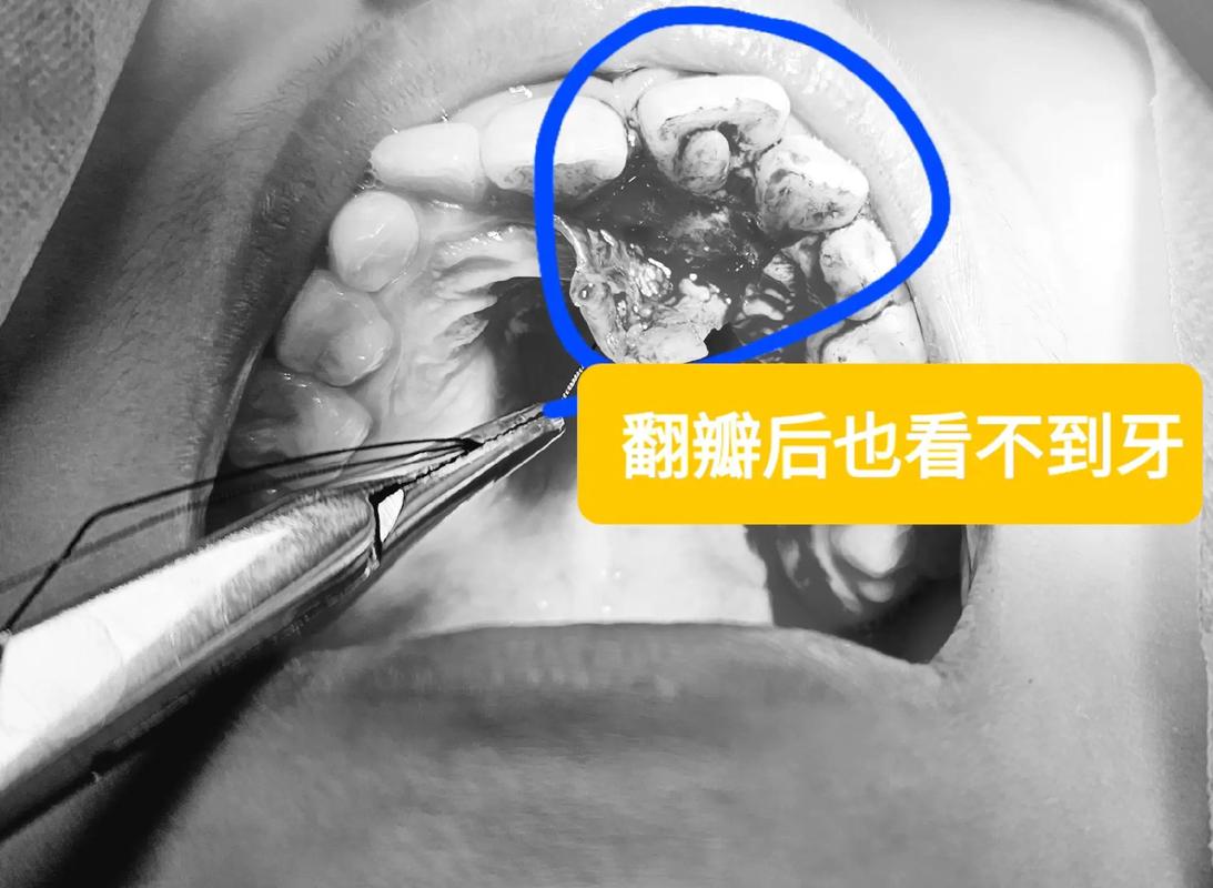 第一例颌骨正畸手术-图2