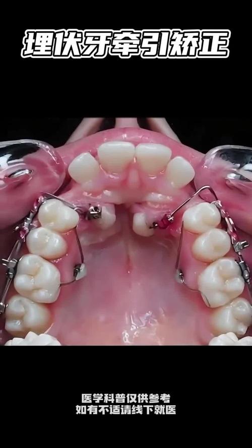 正畸牵引钩与颊面管的应用要点及协同方法有哪些？-图1