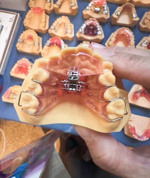 正畸骨性二类是什么-图2