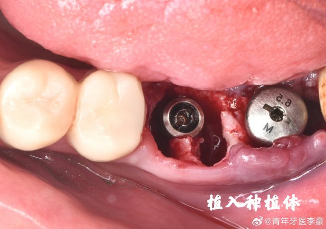 即刻种牙恢复期，多久能好？恢复期要注意什么？-图2