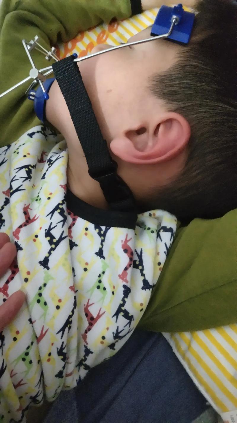 地包天正畸的具体作用有哪些？-图3