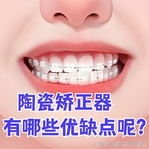 陶瓷正畸一般多少钱-图2