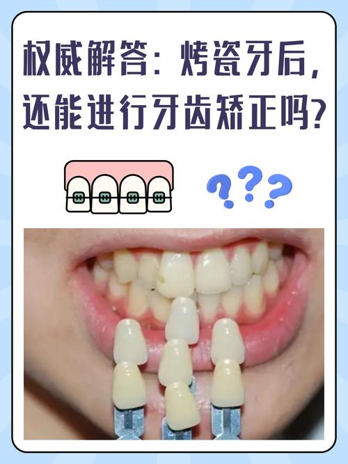 陶瓷正畸一般多少钱-图3