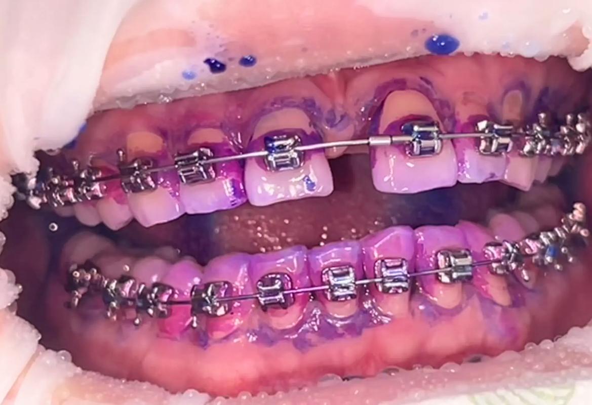 正畸前一定要洗牙吗？洗牙对矫正有必要吗？-图3