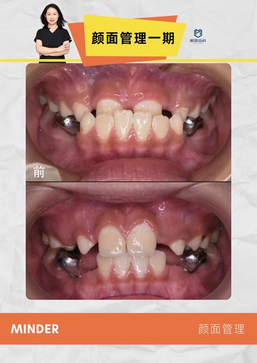 正畸钳变盾了怎么办-图3