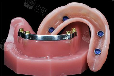 种牙半固定修复与传统修复有何不同？-图1