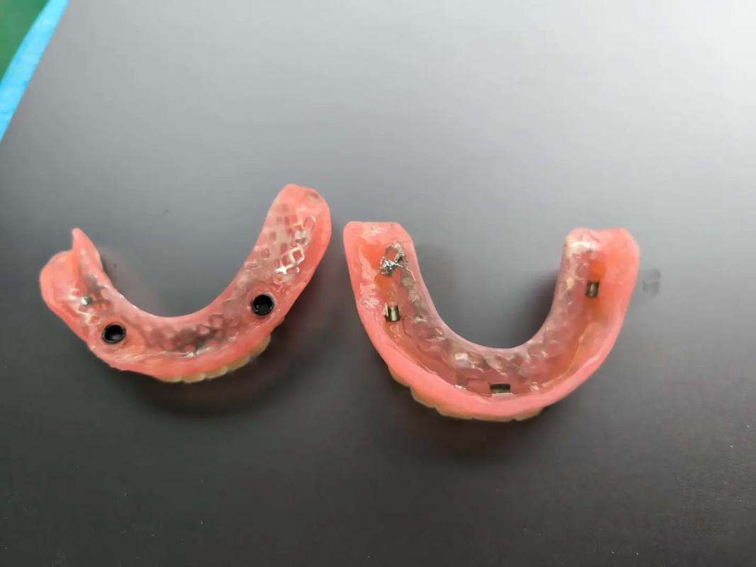 种牙半固定修复与传统修复有何不同？-图2