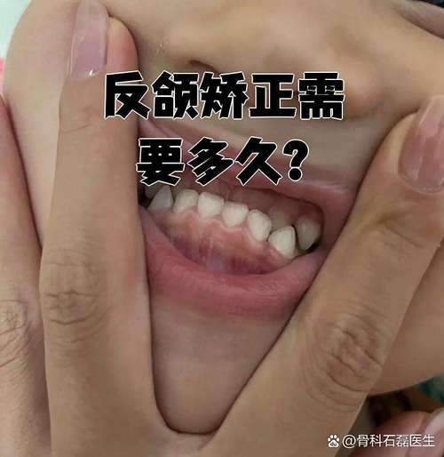 骨性反颌能不能正畸-图1