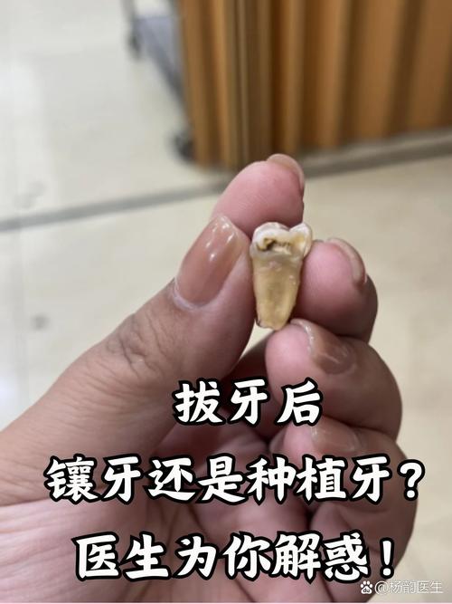 镶牙后为何需重新种牙?是镶牙失败还是另有原因?-图3 镶牙后为何需重新种牙?是镶牙失败还是另有原因?-图3