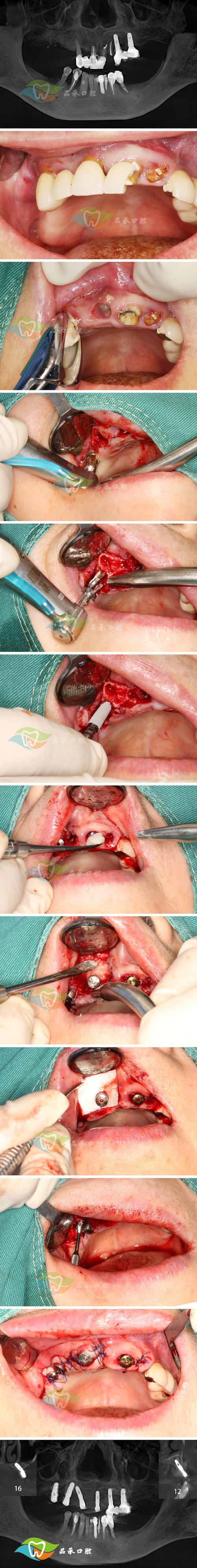 牙骨正畸手术后遗症可能引发哪些长期健康影响？-图2