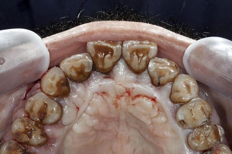 种牙后的牙周病-图2