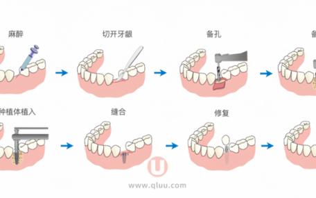 种牙的治疗过程-图2