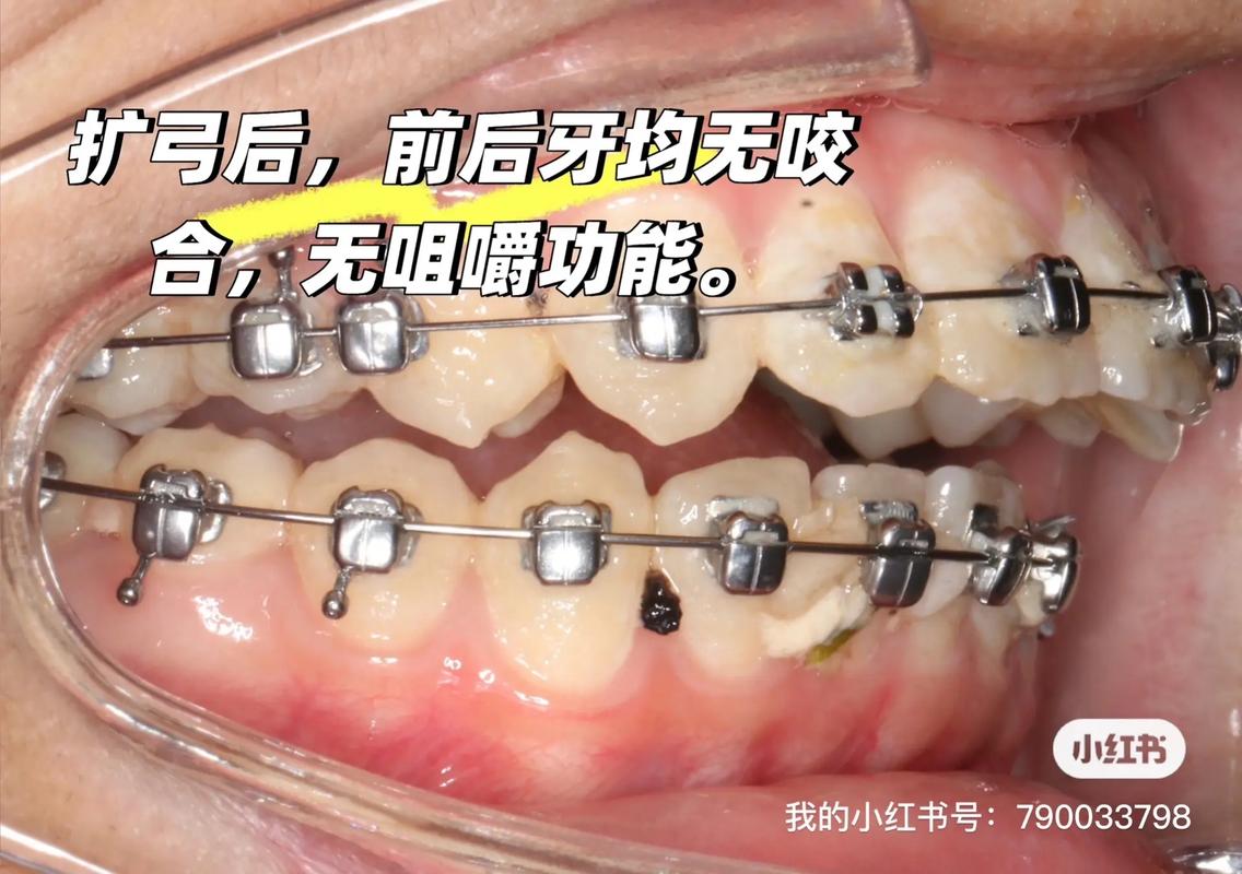 只扩弓不正畸可以吗-图3