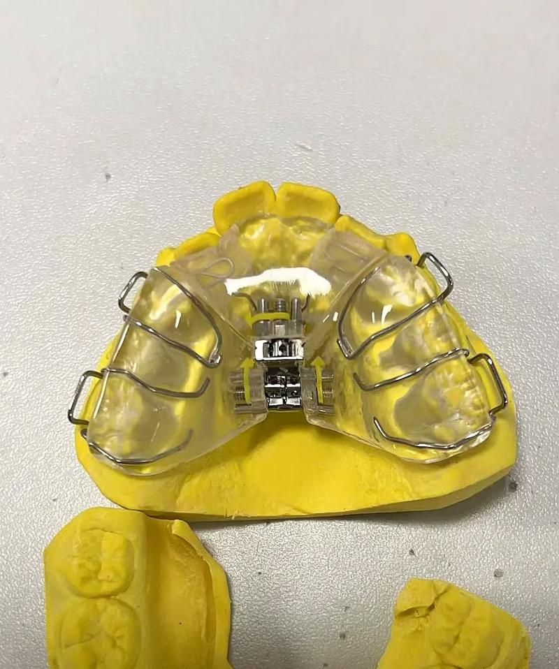 只扩弓不正畸可以吗-图2