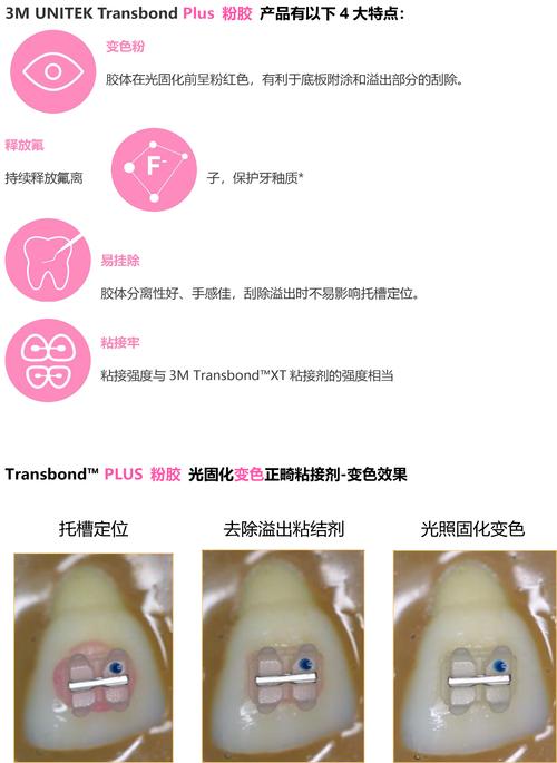 正畸粘结剂什么的好-图1