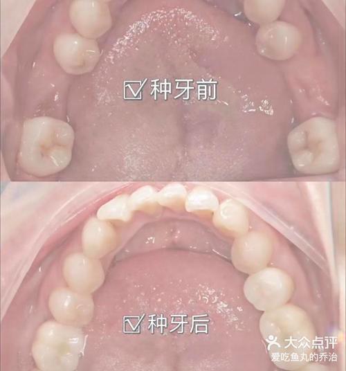 潍坊种牙哪家好-图3