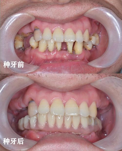 下切牙缺失种牙-图2