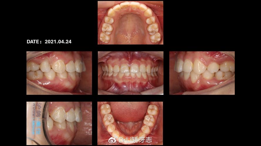 下切牙缺失种牙-图3