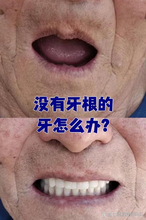 牙齿都没了种牙-图1