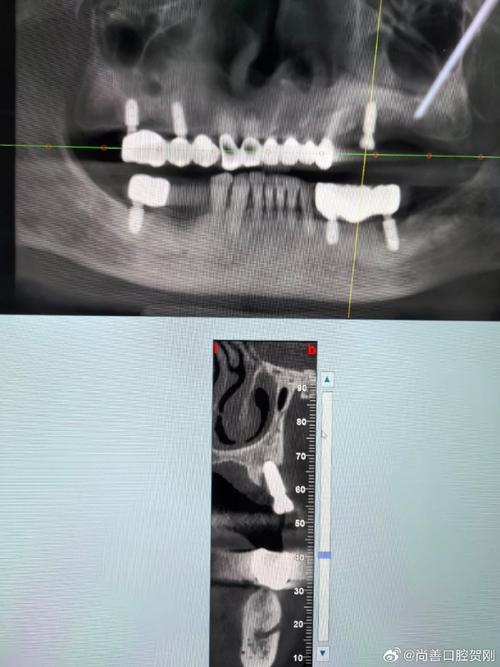 牙齿都没了种牙-图2
