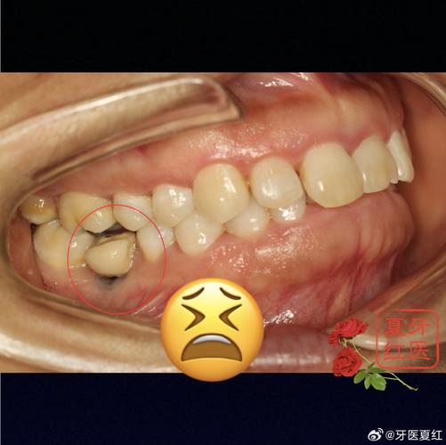 牙齿都没了种牙-图3