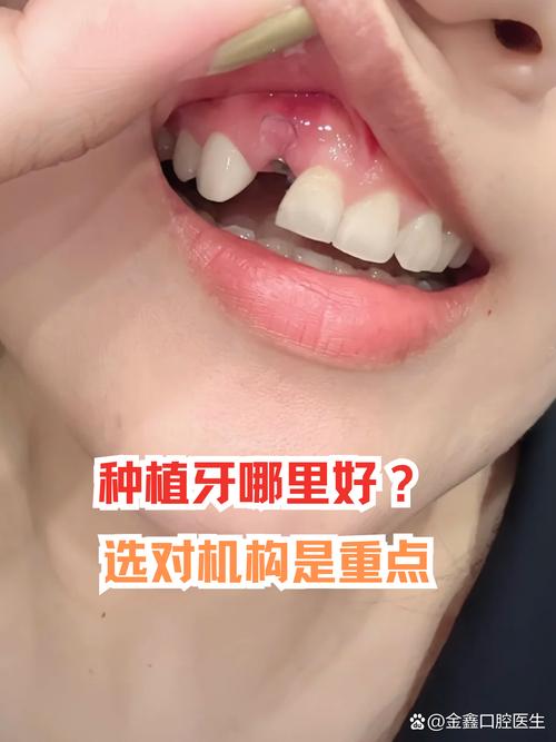 20多岁就种牙，年轻人牙齿提前下岗的原因何在？-图1