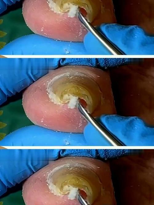 种牙钢钉掉出来-图3