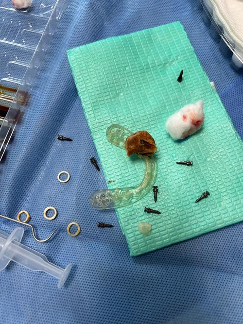 种牙钢钉掉出来-图1