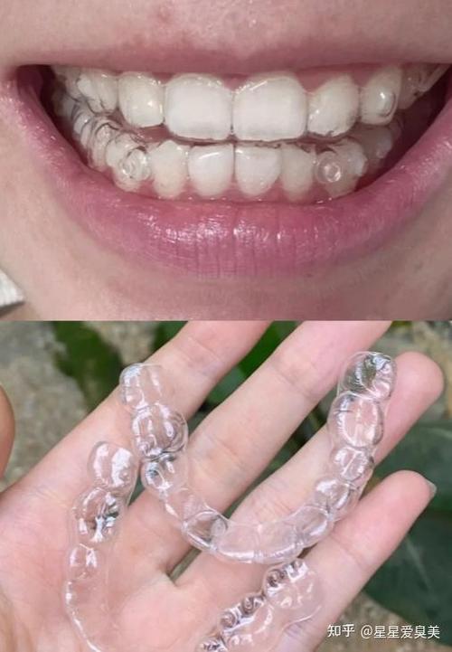 隐形牙有多少种-图3