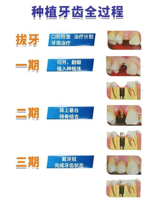 种牙系统是什么-图3