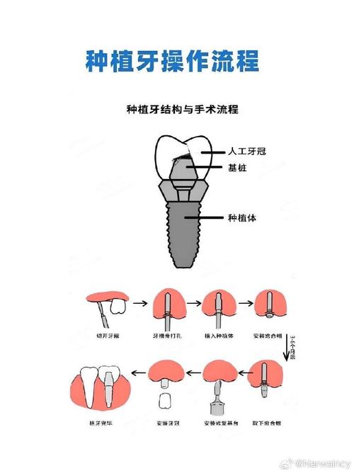 种牙系统是什么-图2