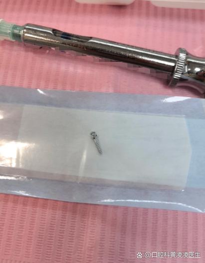 正畸打骨钉会脱落吗-图3