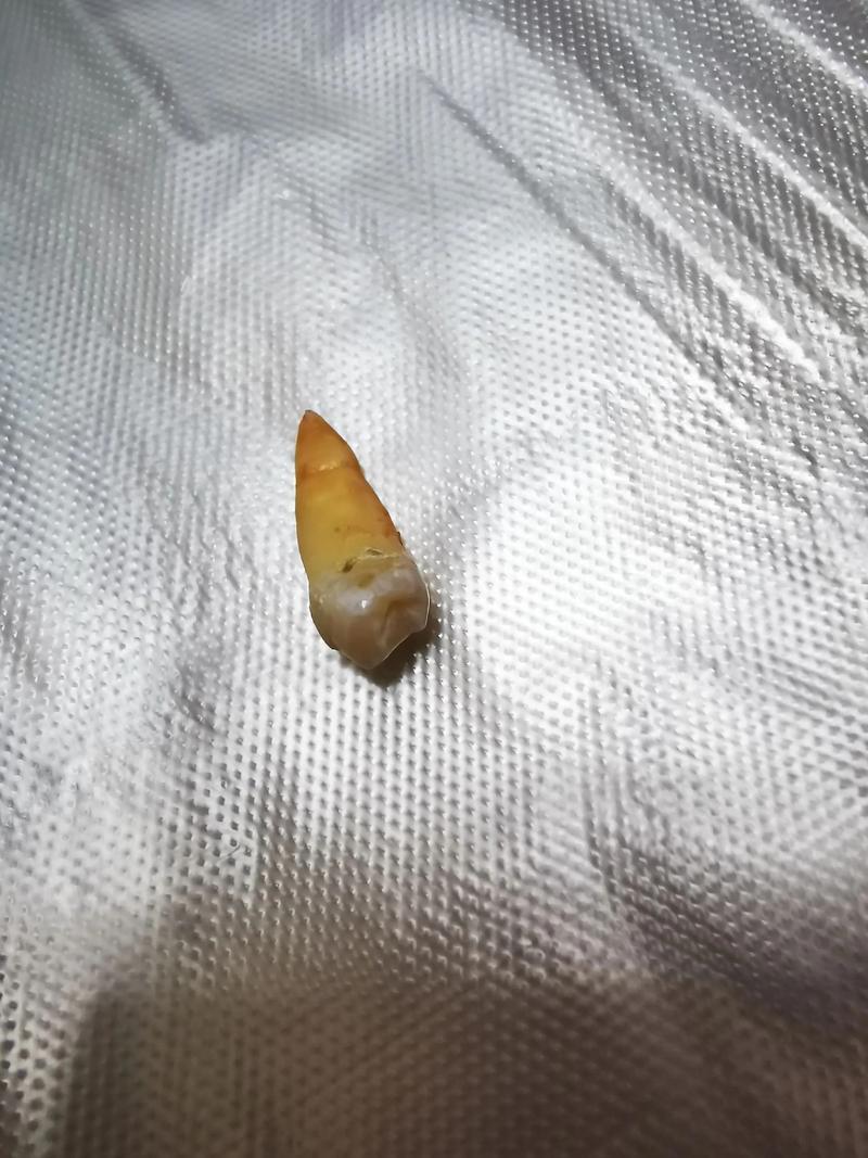 正畸牙拔完后痛几天-图1