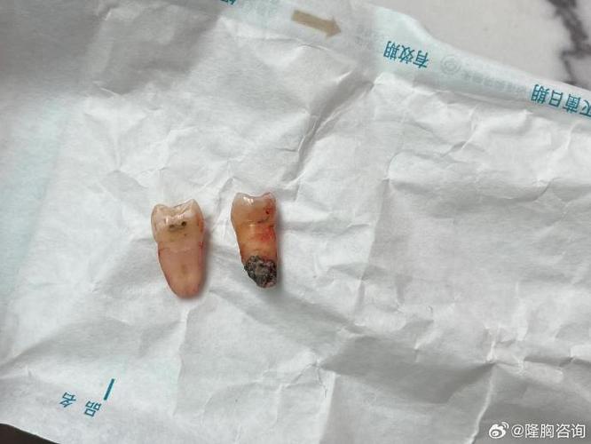 正畸牙拔完后痛几天-图3