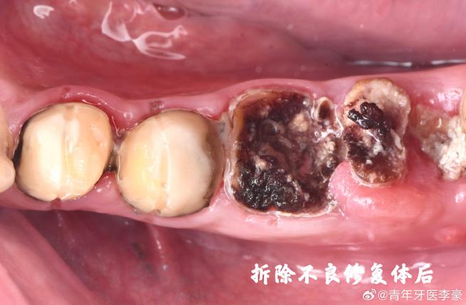 磨牙种牙后保养-图2