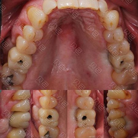 种牙后牙冠高度-图3