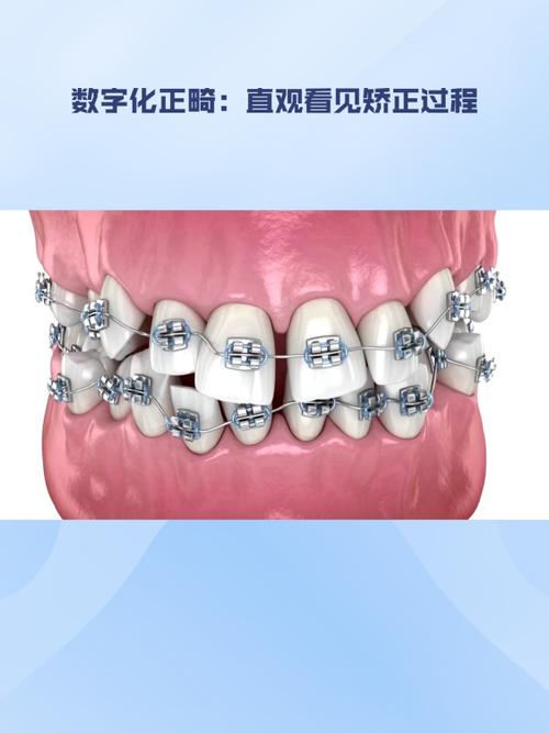 卡瓦数字化传统正畸-图1