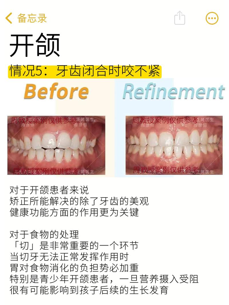 种牙如何精准调咬合？关键步骤有哪些？-图1