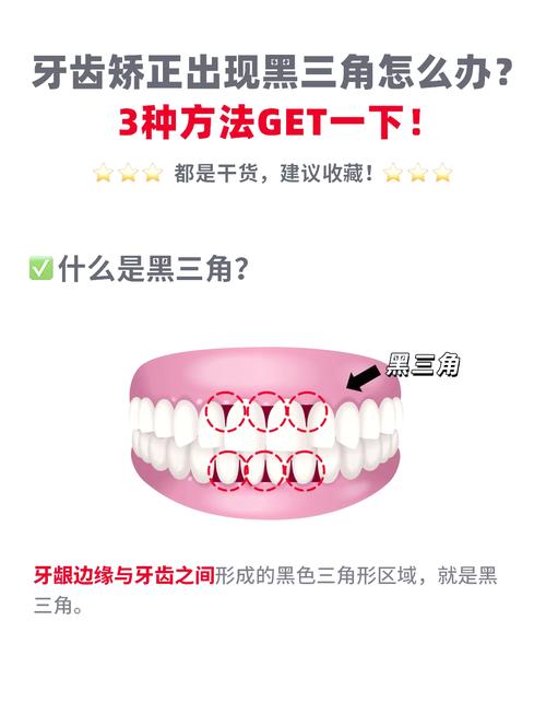 正畸如何关闭黑三角-图1