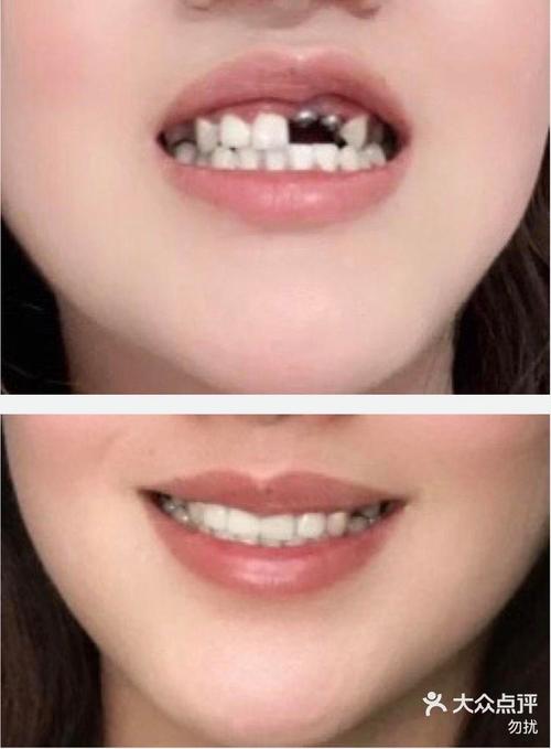 大牙 能种牙吗-图2