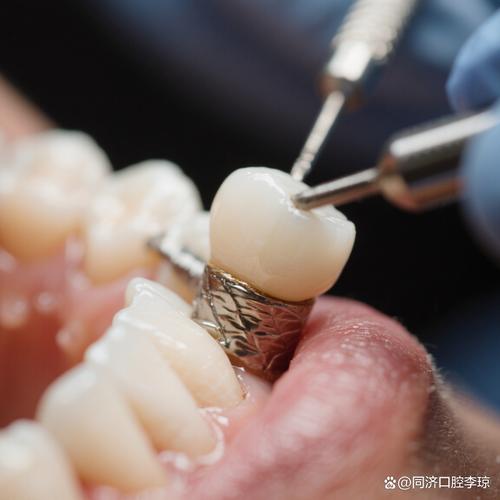 镶牙之后，为何需要换种牙？-图1